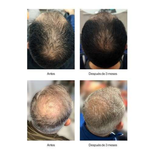 Thader TH Pharma Neoxil Peptide Programa Anticaída Densificante Completo – Concentrado + Champú - Imagen 10